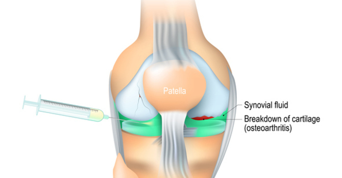 SuPartz FX Knee Injections
